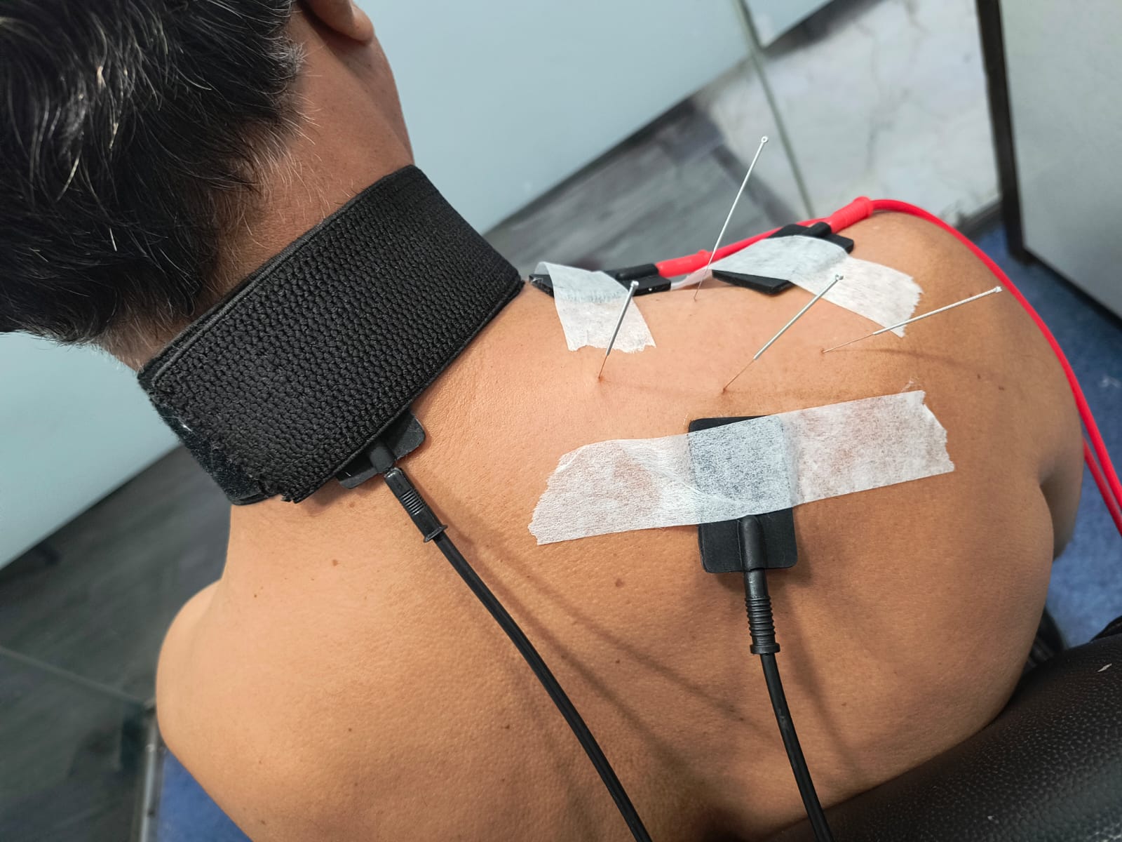 Dry needling & electrotherapy